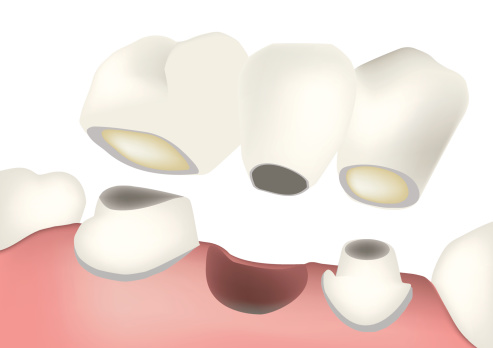 A bridge is two or more crowned teeth connected together