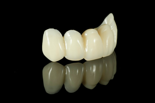 bridge is two or more crowned teeth