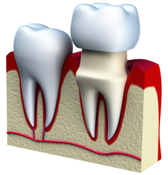 A bridge is two or more crowned teeth