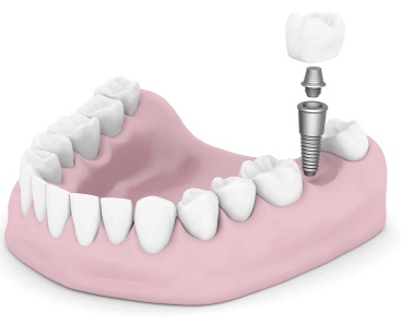 Dental Implant Restoration - Boyd and Messerly DDS