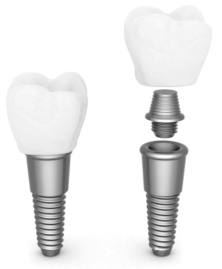 Dental Implant Restoration - Dentist in Lancaster, Ohio