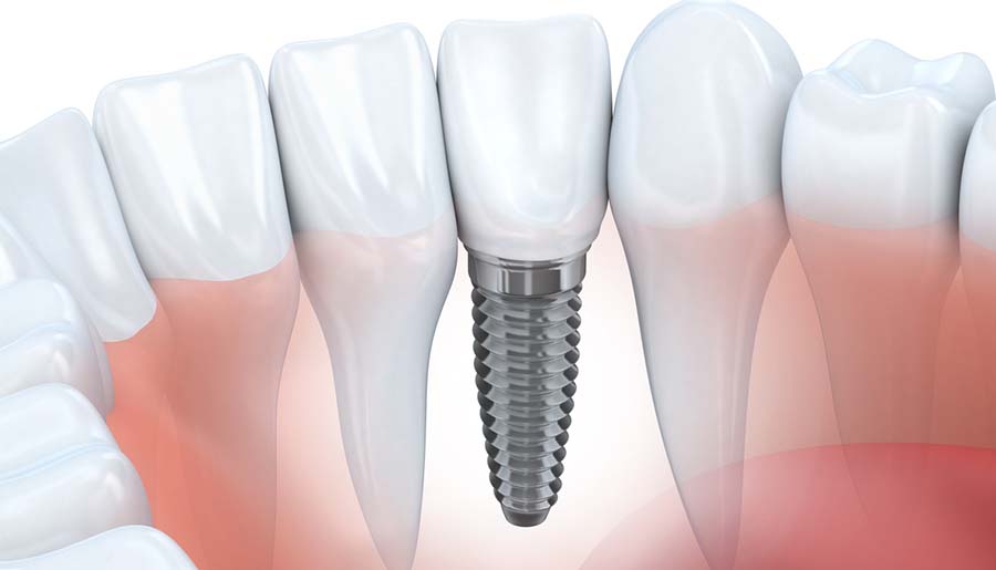 Tooth human implant (done in 3d graphics)